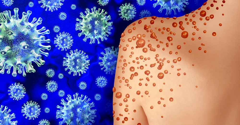 Monkey Pox or Monkeypox Virus Outbreak as a contagious infection as blisters and leisons on the skin representing transmission of an infected person with 3D illustration elements.